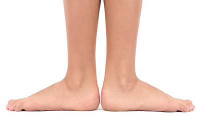 Flat-Feet-in-children