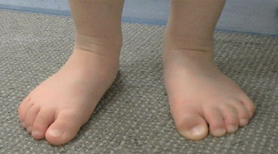 Flat-feet-In-Children