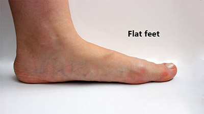 flat-feet