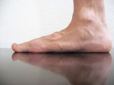 Understanding-Flat-Foot