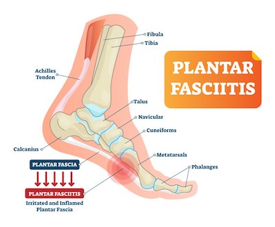 causes-of-plantar-fasciitis