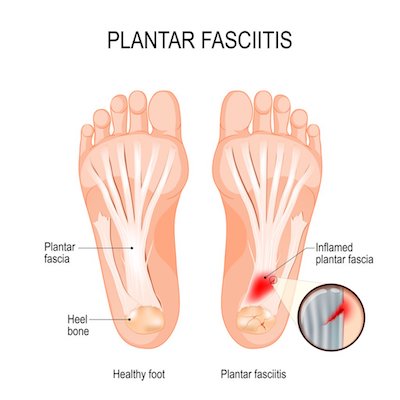 home-remedies-for-plantar-fasciitis-1